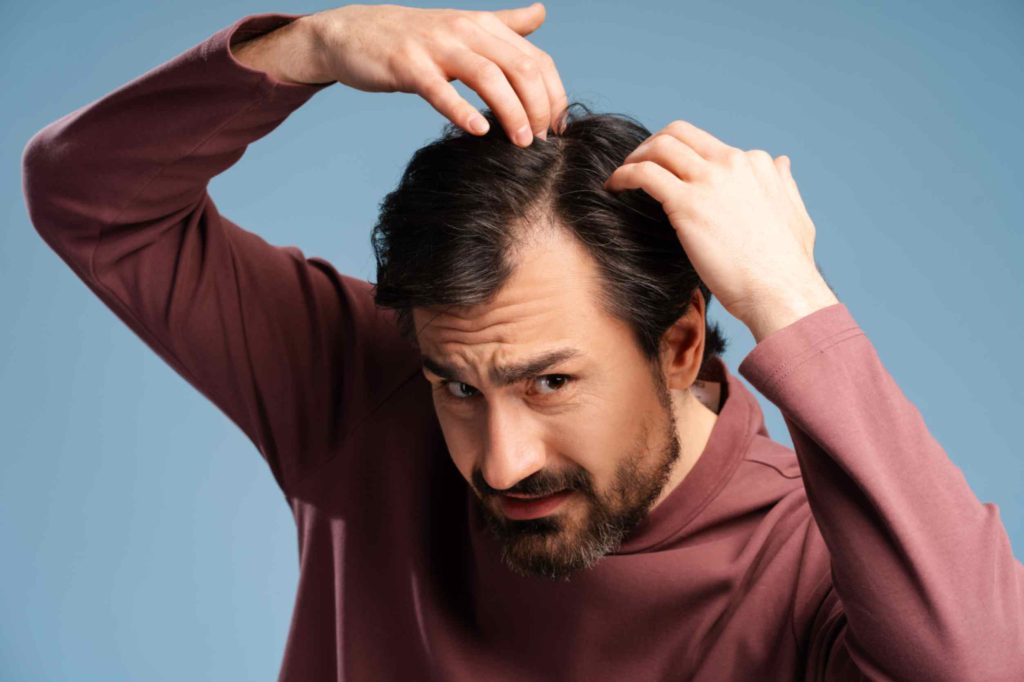 Male pattern baldness early signs